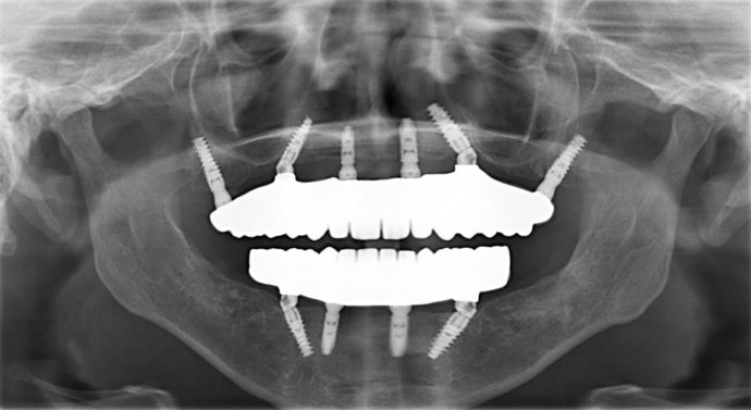 All-on-4/ Full Mouth Dental Implants / Teeth in a Day: Case 9-WA- Upper and lower All-on-4 bridges - After
