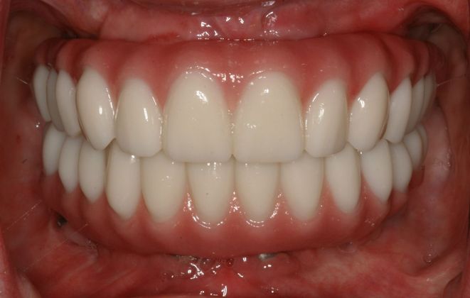 All-on-4/ Full Mouth Dental Implants / Teeth in a Day: Case 10-GC- Upper and lower All-on-4 bridges - After