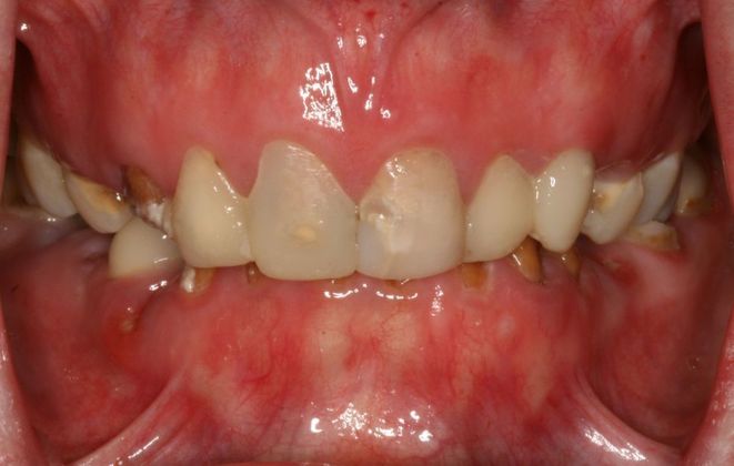All-on-4/ Full Mouth Dental Implants / Teeth in a Day: Case 10-GC- Upper and lower All-on-4 bridges - Before