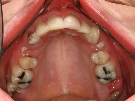 All-on-4/ Full Mouth Dental Implants / Teeth in a Day: Case 10-GC- Upper and lower All-on-4 bridges - Before