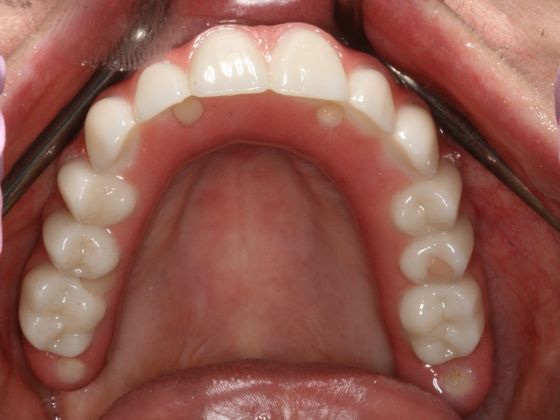 All-on-4/ Full Mouth Dental Implants / Teeth in a Day: Case 10-GC- Upper and lower All-on-4 bridges - After