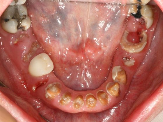 All-on-4/ Full Mouth Dental Implants / Teeth in a Day: Case 10-GC- Upper and lower All-on-4 bridges - Before