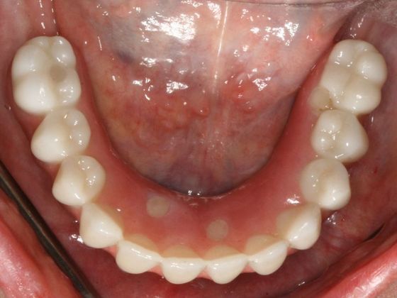 All-on-4/ Full Mouth Dental Implants / Teeth in a Day: Case 10-GC- Upper and lower All-on-4 bridges - After