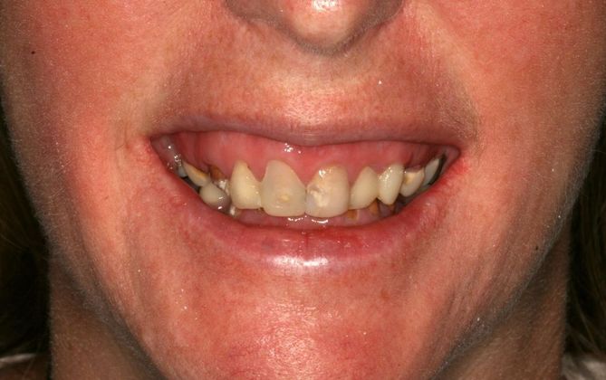 All-on-4/ Full Mouth Dental Implants / Teeth in a Day: Case 10-GC- Upper and lower All-on-4 bridges - Before