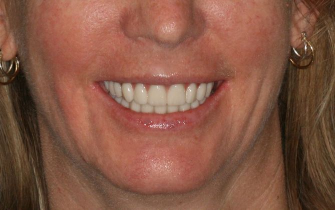 All-on-4/ Full Mouth Dental Implants / Teeth in a Day: Case 10-GC- Upper and lower All-on-4 bridges - After