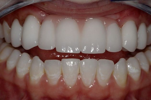 Dental Implants Case 5 - After