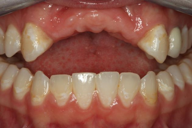 Dental Implants Case 5 - Before