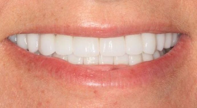 Full Mouth Reconstruction: Case 7 - After