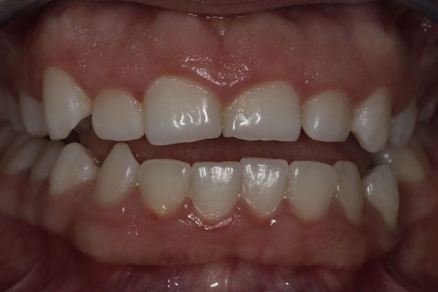 Laser Gum Reshaping Case 6 - Before