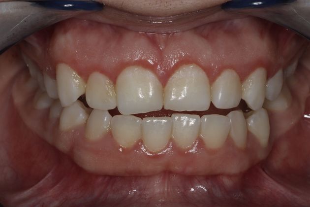 Laser Gum Reshaping Case 6 - After