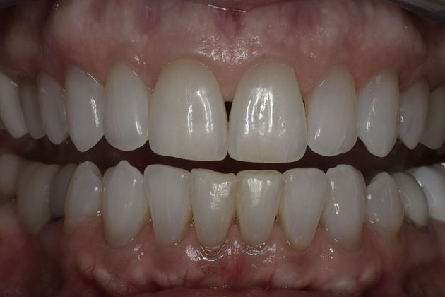 Invisalign Case 2 - After