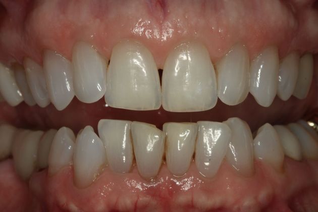 Invisalign Case 2 - Before