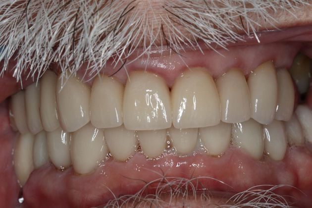 Dental Crowns: Case 4 - After