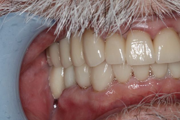 Dental Crowns: Case 4 - After