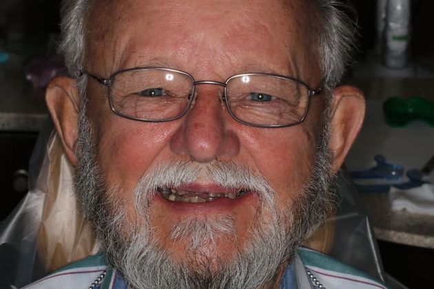 Dental Crowns Case 4 - Before