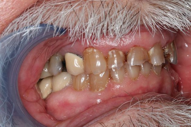 Dental Crowns: Case 4 - Before