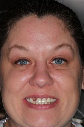 Dental Implants Case 1 - Before