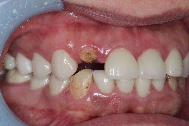 Dental Implants: Case 1 - Before