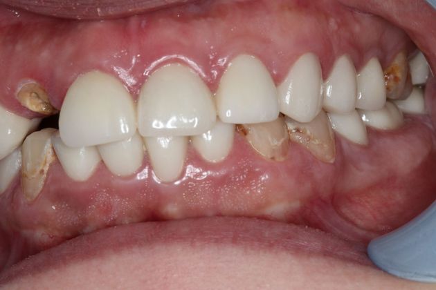 Dental Implants: Case 1 - Before