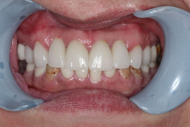 Dental Implants: Case 1 - After