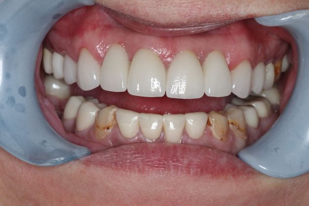 Dental Implants: Case 1 - After