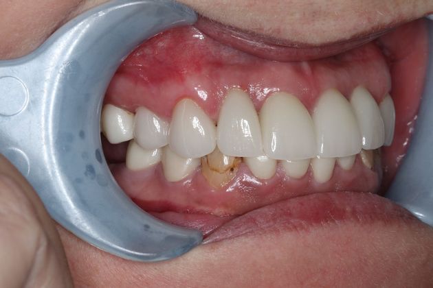 Dental Implants: Case 1 - After