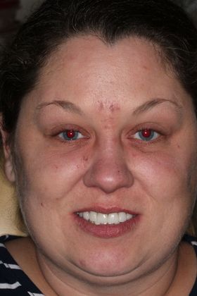 Dental Implants Case 1 - After