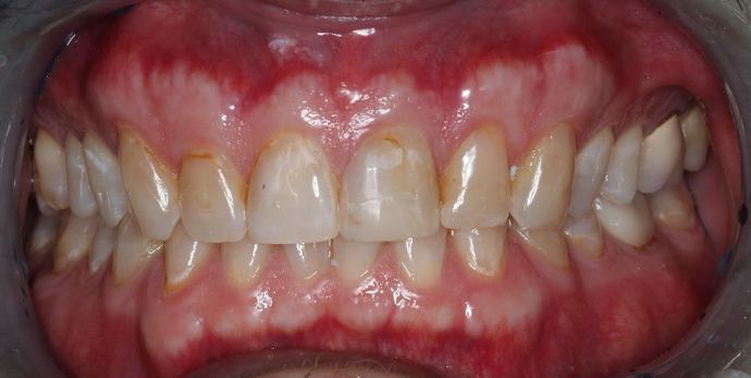 Veneers: Case 4 - Before