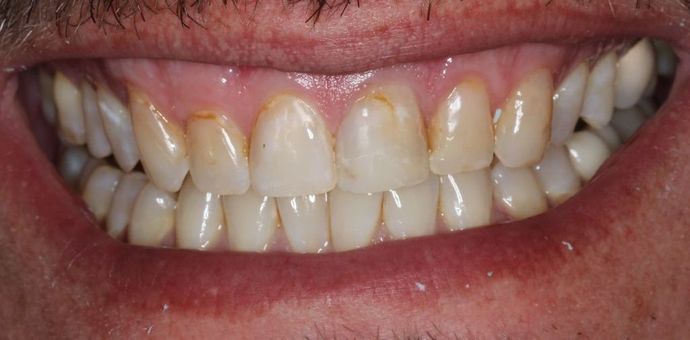 Veneers Case 4 - Before
