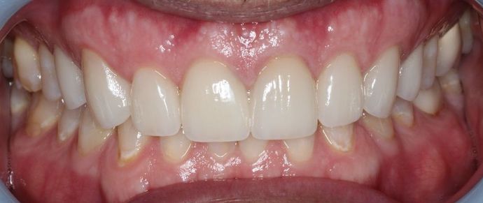 Veneers: Case 4 - After