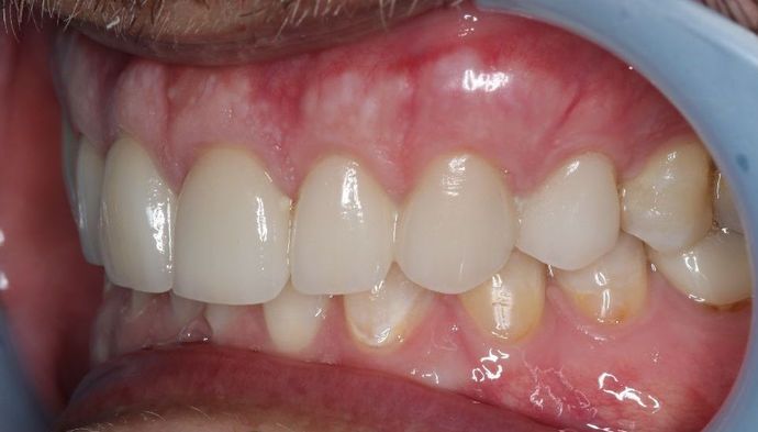 Veneers: Case 4 - After