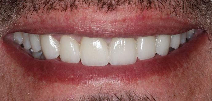 Veneers Case 4 - After