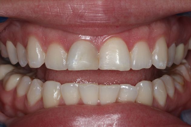 Dental Crowns: Case 5 - Before