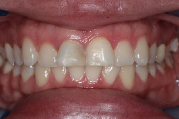 Dental Crowns Case 5 - Before