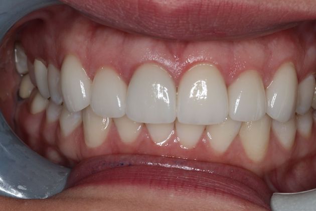 Dental Crowns Case 5 - After
