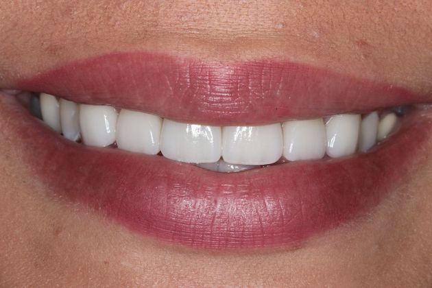 Dental Crowns: Case 5 - After