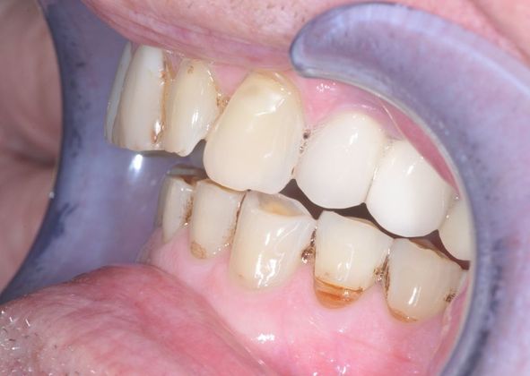 Dental Crowns: Case 6 - Before