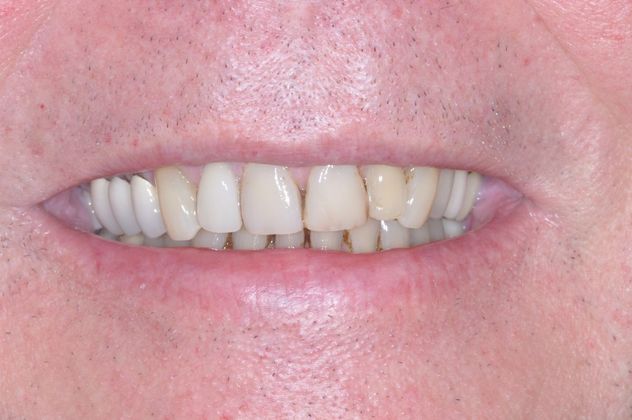 Dental Crowns Case 6 - Before