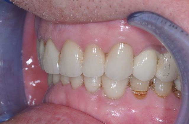 Dental Crowns: Case 6 - After