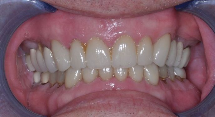 Dental Crowns: Case 6 - After
