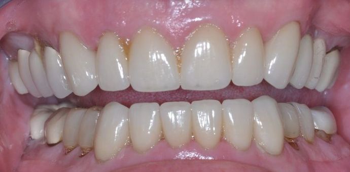 Dental Crowns Case 6 - After