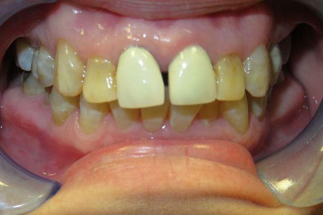 Dental Crowns Case 7 - Before