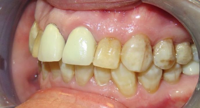 Dental Crowns: Case 7 - Before
