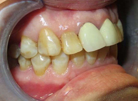 Dental Crowns: Case 7 - Before