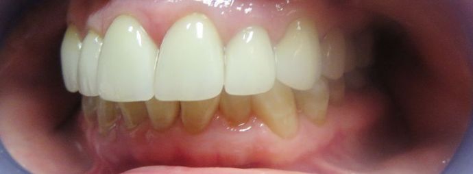 Dental Crowns: Case 7 - After