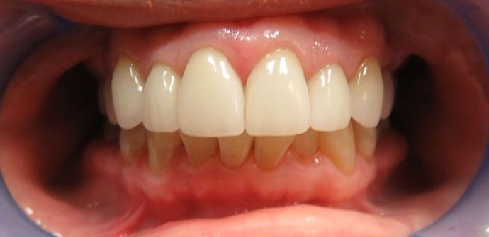 Dental Crowns: Case 7 - After