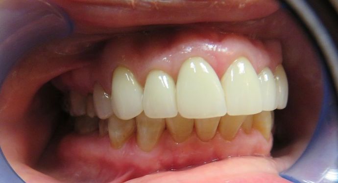 Dental Crowns: Case 7 - After