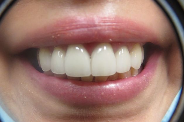 Dental Crowns Case 7 - After