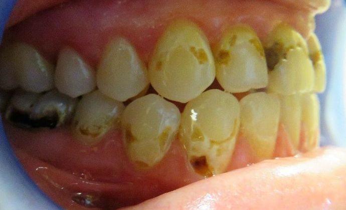Dental Crowns: Case 8 - Before