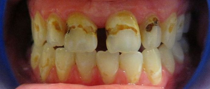 Dental Crowns Case 8 - Before